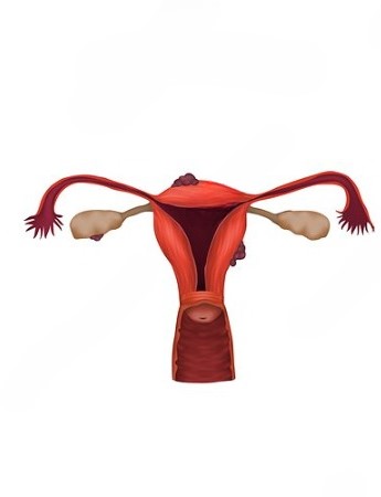Endometriosis